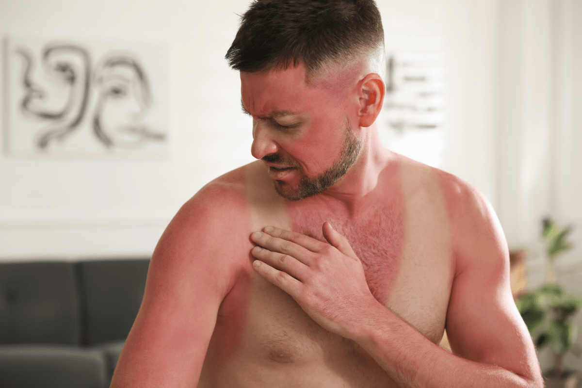 A man with a severe sunburn touching his shoulder, showing redness and discomfort indoors.